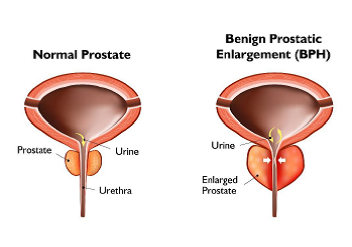 Prostate image